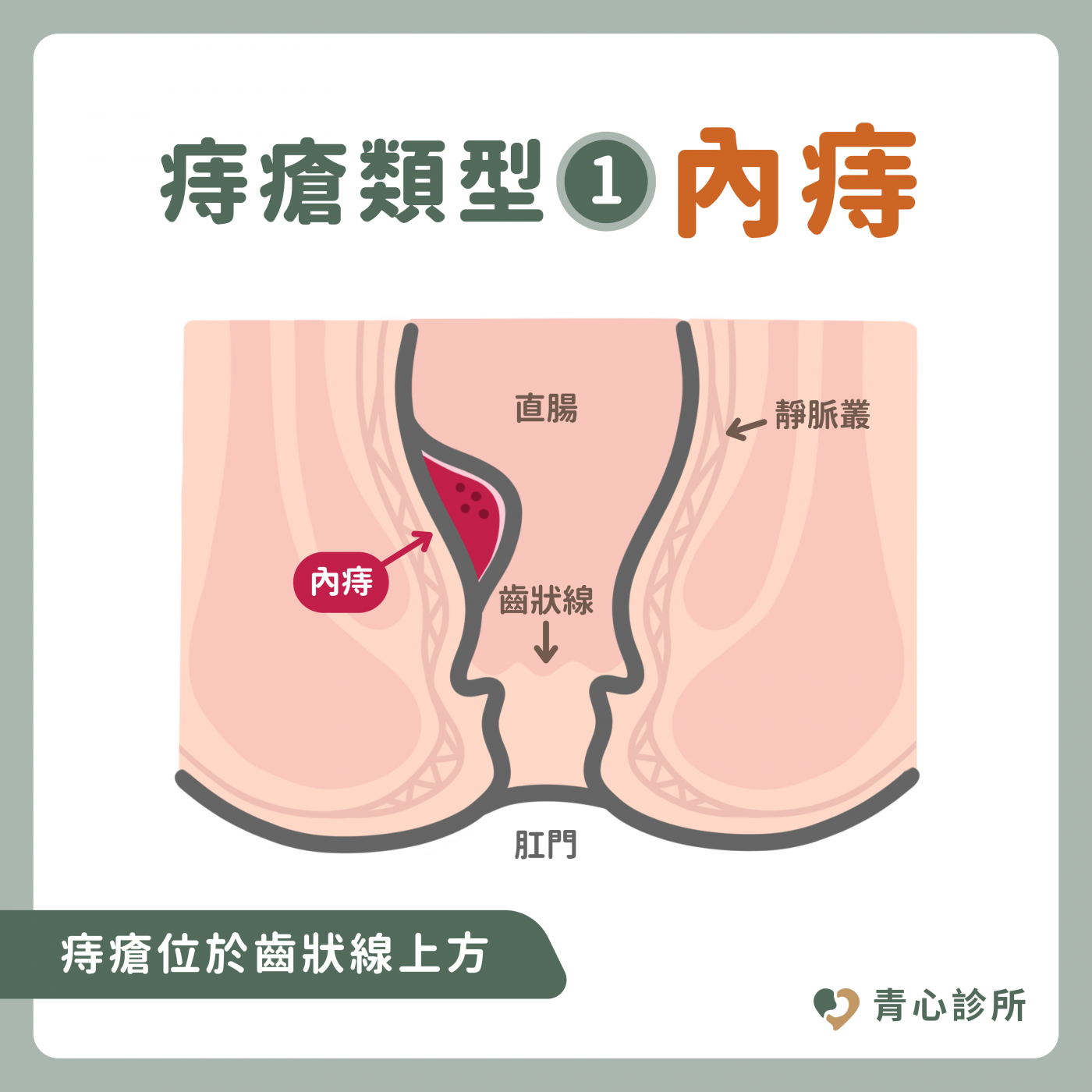內痔瘡示意圖