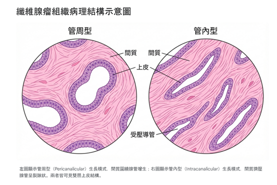 良性乳房腫瘤特徵：邊界清晰可滑動示意圖