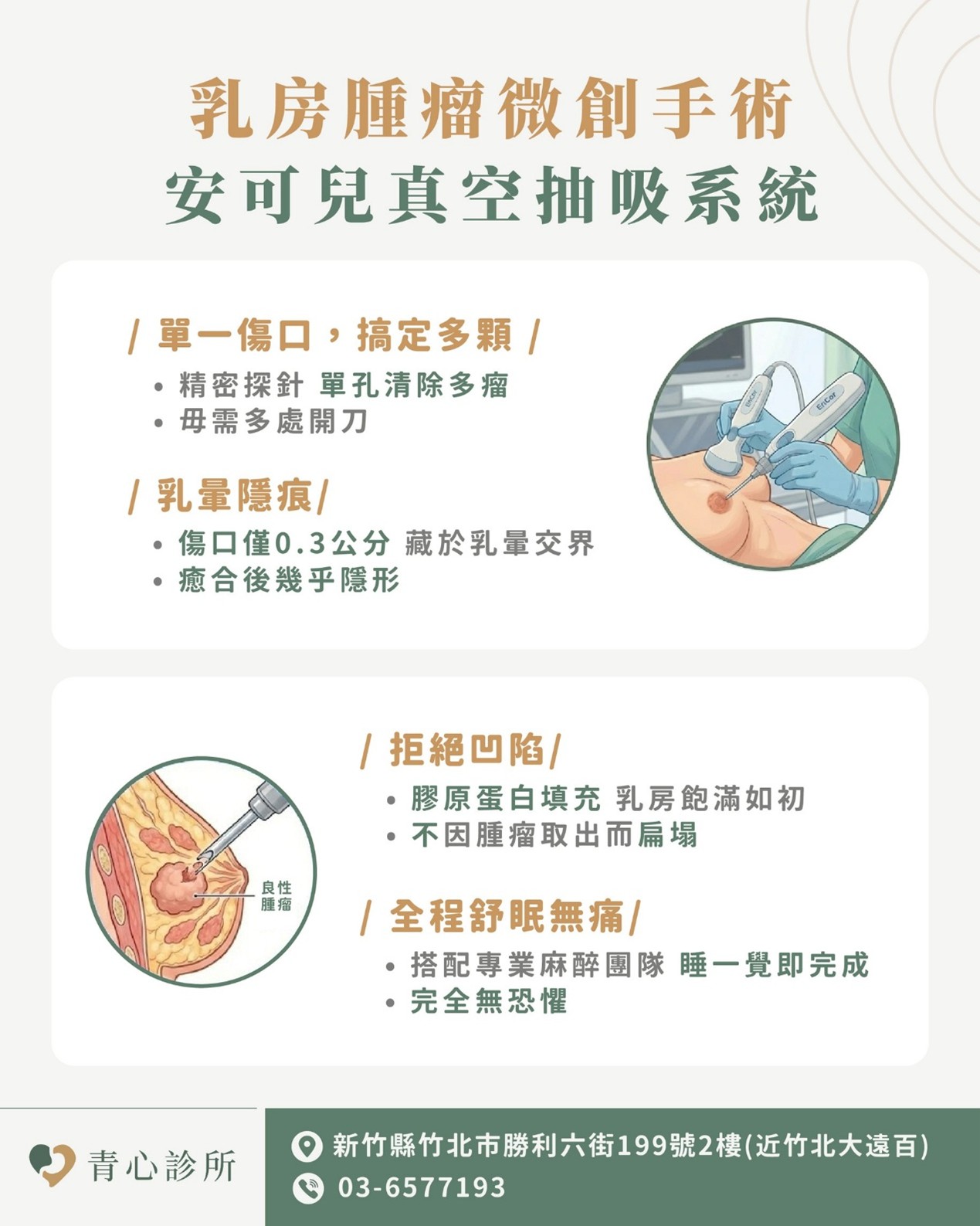 真空輔助微創手術(VABB)治療復發型囊腫示意圖